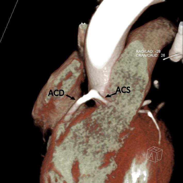 CT koronarografie - indikace Bypassy anastomozy i průběh bypassů
