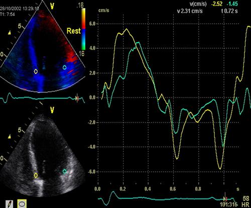 ECHO Tkáňový doppler (DTI) během vyšetřování pacienta Speckle tracking (STE) nutný software