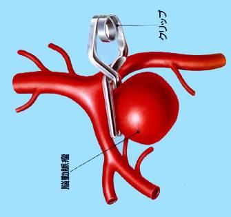 Rozdělení CMP Mozkový infarkt 75-80% Intracerebrální krvácení