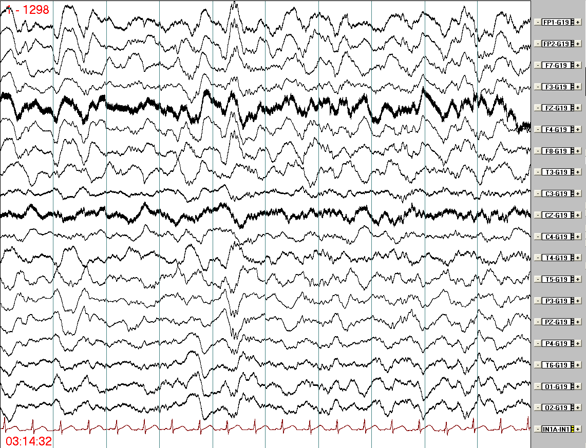 EEG