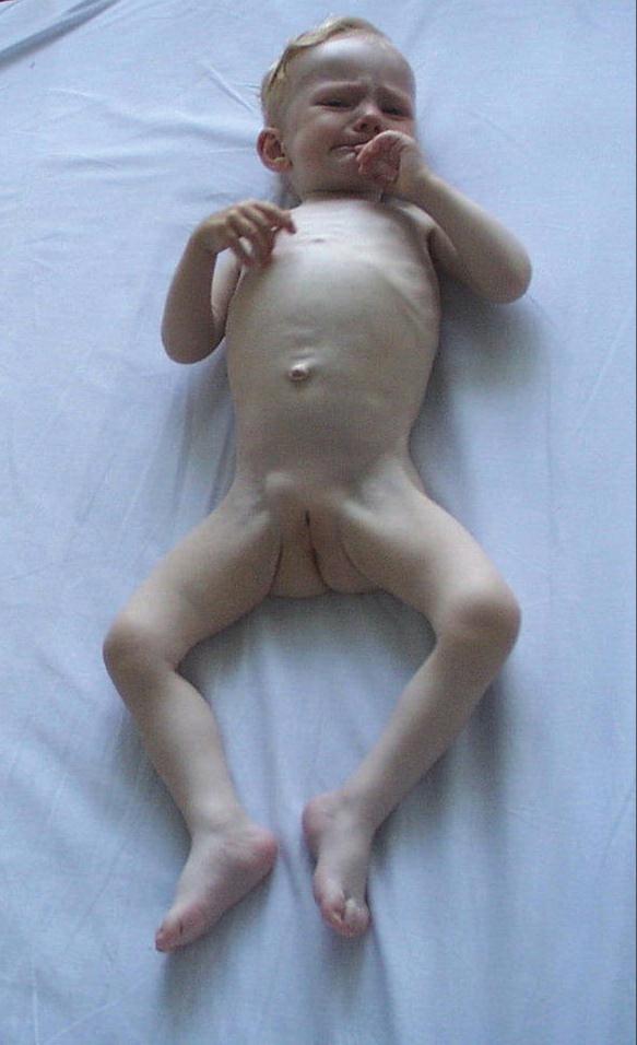 Dítě s celiakií 19m věku hmotnost 7,7kg (<3.p.