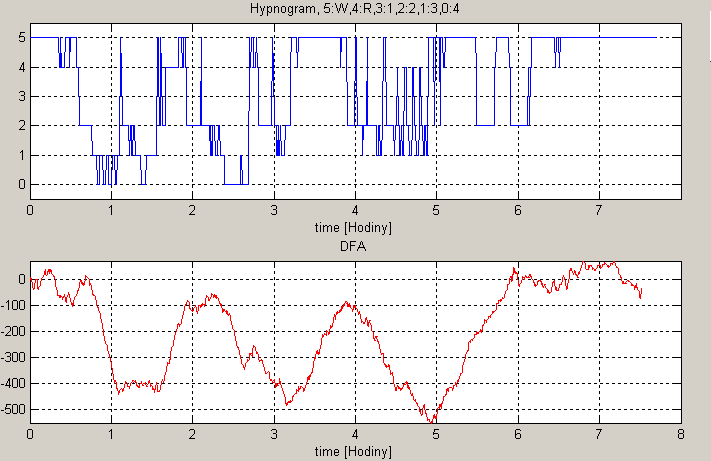 Obrázek 12: od shora 1)EKG 2)RR interval 3)hypnogram ze