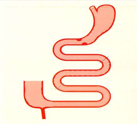 Současná diagnostika CS ESPGHAN (1990) 1) anamnéza, klinický obraz, protilátky a histologie kompatibilní s dg.