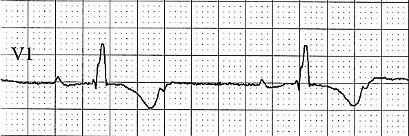 Bradykardie EKG bradykardie Definice: frekvence komor pod 60/min (50min) Tedy při posunu papíru 25mm/s je mezi QRS komplexy více než 5 (6) velkých čtverců Klinický obraz: Syndrom nízkého minutového