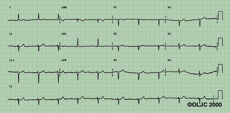 Semikvantitativní určení osy HO horizontální osa, QRS komplexy ve svodech avl a avf jdou od sebe. To je ta nepravá láska?. Je třeba pomýšlet na levý přední hemiblok.