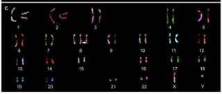 Trisomie 8 formaldehyd Totální trisomie neslučitelná se životem Mozaiková trisomie vážné klinické projevy Impact of trisomy 8 (+8) on clinical