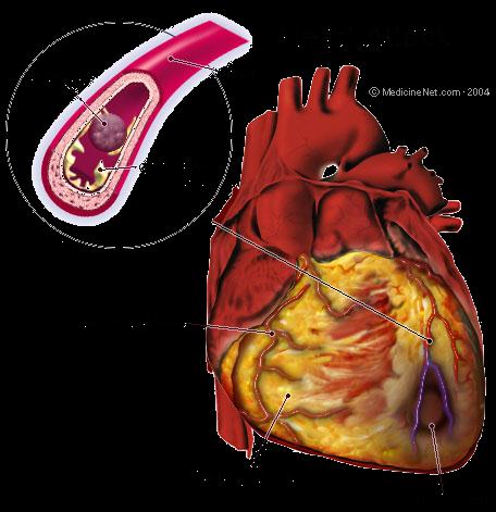 Eur Heart J 2005 Brainard AH et al. The prehospital 12-lead ECG s effect on time to reperfusion therapy.