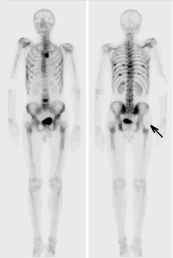 2.8.5 Zdroje chyb při scintigrafii skeletu Tak jako u všech zobrazovacích metod, tak i u scintigrafických vyšetření se vždy nevyhneme příčinám vzniku chyb, které mohou na snímcích vyvolat artefakty.