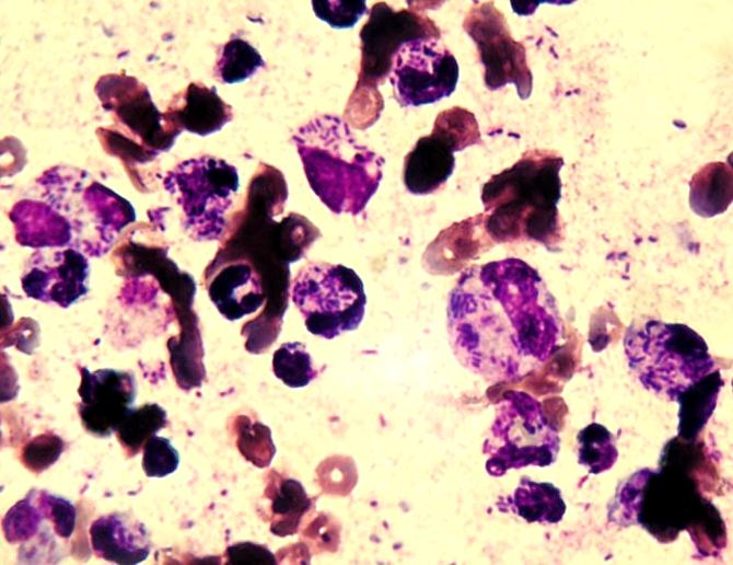 SAA Sérový amyloid A Marker systémové zánětlivé reakce. Výrazné zvýšení u bakteriálních infekcí.