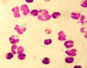 Diagnostika proteinurie Prerenální(Bence-Jones p.