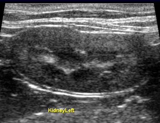 Cystatin C Spolehlivý marker glomerulární filtrace. Diagnostika časného renálního onemocnění.