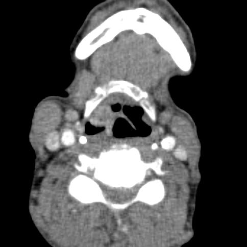 Thyroglosální relikty Cysty ductus thyreoglossus Struma linguae base jazyka, laterální hrana epiglotidy Ektopický thyroideální karcinom