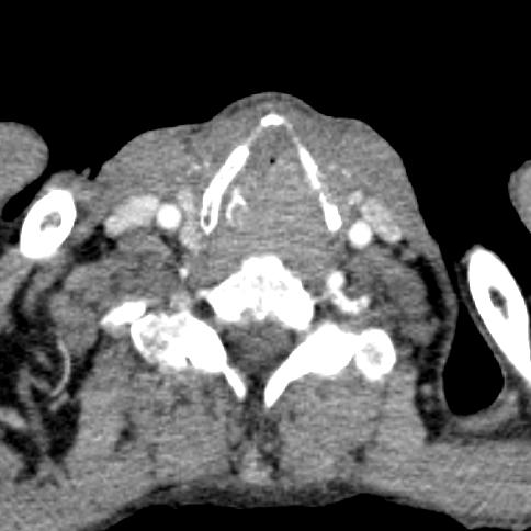 Karcinom hrtanu T1 Supraglotický Glotický Je možné využít doplňkové zobrazení ve