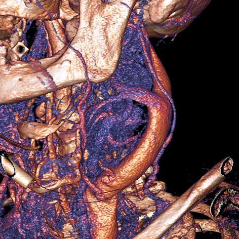 Paragangliomy Vysoce vaskularizované neuroendokrinní nádory uložené v karotickém prostoru maligní varianty tvoří rozsáhlé infiltrace krku