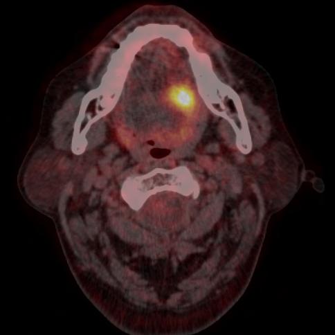 hypofarynx - fixace hlasivky T4: invaze do extraglosárních