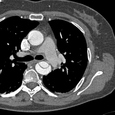 aortální disekce Ruptura (A, B) Hemoperikard - srdeční tamponáda (A) Mozková ischemie