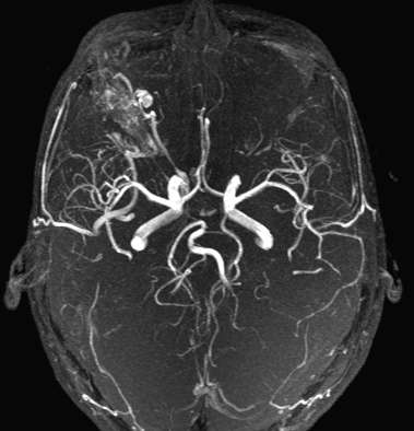 MR angiografie Výhody - Bez radiace - Moţno provádět i bez KL Nevýhody - Dlouhé akvizice - Niţší prostorové rozlišení - Více artefaktů Indikuje se
