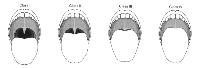Mallampati 1. měkké patro, uvula, hltan, tonzily vše 2. měkké patro a uvula 3. měkké patro a kořen uvuly 4.