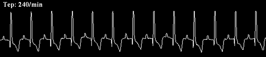 Tachyarrhythmias