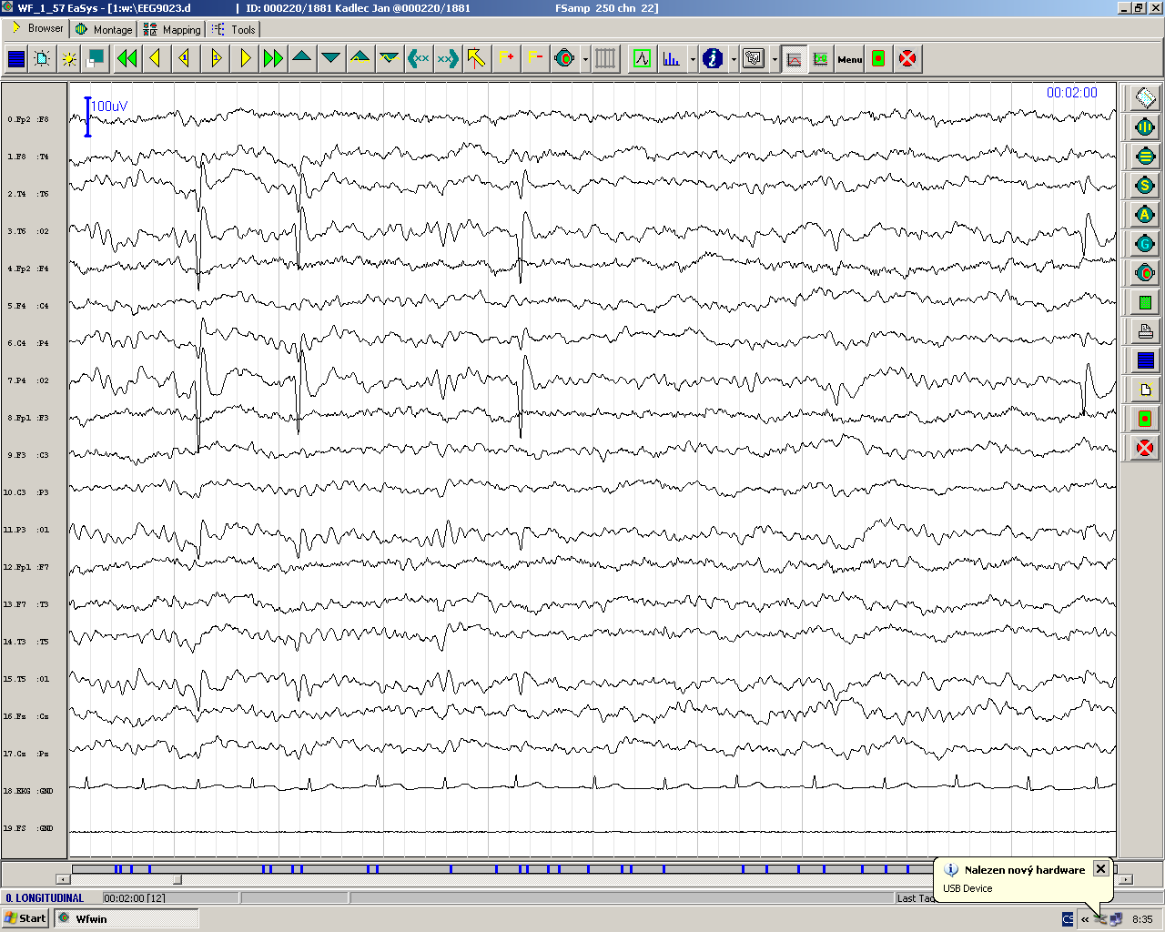 EEG -záznam elektrické aktivity mozku ložiskové či generalizované epileptiformní výboje