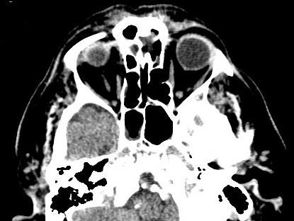 Kazuistika 2 CT mozku: Korová atrofie, malá v.s. postischemická ložiska v BG oboustranně, ARTS vertebrální tepny oboustr.