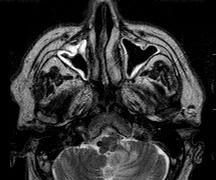 Kazuistika 3 MR mozku: Akutní ischémie v povodí PICA (dolní mediální část L mozečku susp.