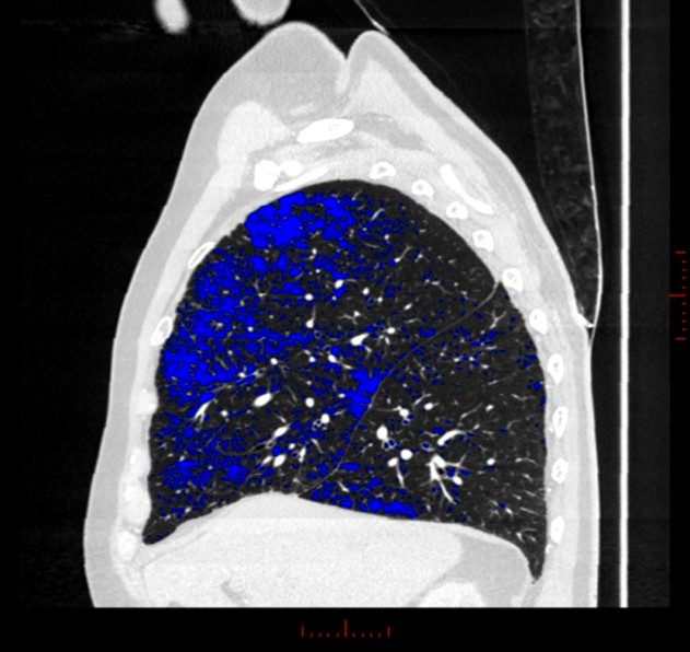 Thoracic