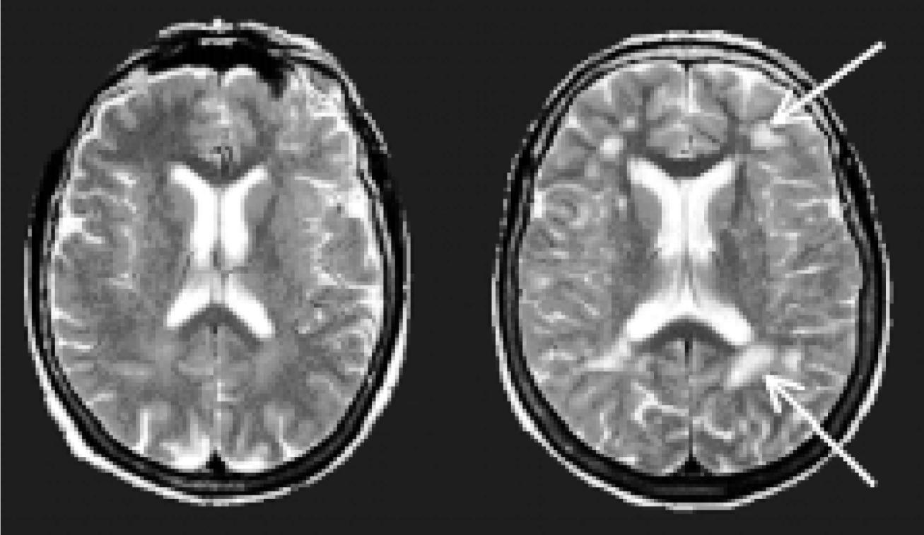Subklinická orgánová poškození mozku NMR HYPERDENZITY BÍLÉ