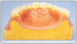 14. kapitola Plastické hmoty Ad 4. je vhodná na zpracování korunek. Modeluje se přímo na modelu hustou pryskyřičnou hmotou do požadovaného tvaru a polymeruje se v hydropneumatickém polymerátoru.