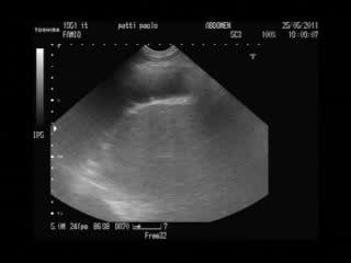 septované pleurální výpotky Exudativní stadium: částečky s rozdílnou echogenitou v tekutině Fibrinopurulentní stadium: zesílení pleury, lokulovaná i tekutina