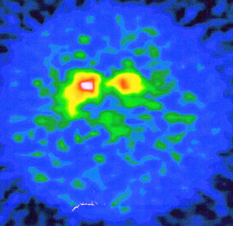 objektivní nález: tremor unilaterální - PHK zejména posturální akineza snížená synkineza PHK rigidita stupně 1 diferenciální diagnóza: esenciální tremor Wilsonova nemoc strukturální léze BG