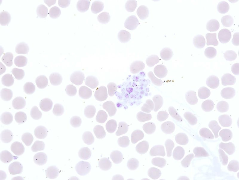 Klasifikace trombocytopenie Pseudotrombocytopenie Diluční Gestace Masivní výměnná transfúze ( 10 EBR) Pseudotrombocytopenie satelitismus( shlukování) destiček v roztoku EDTA 1/1000 vzorků Klinické