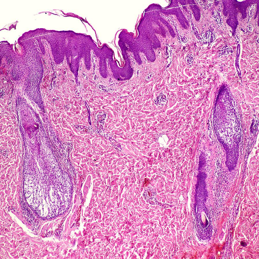 3. Atypický epitelový hlen-alopecia mucinosa 3 Epidermis Korium 3
