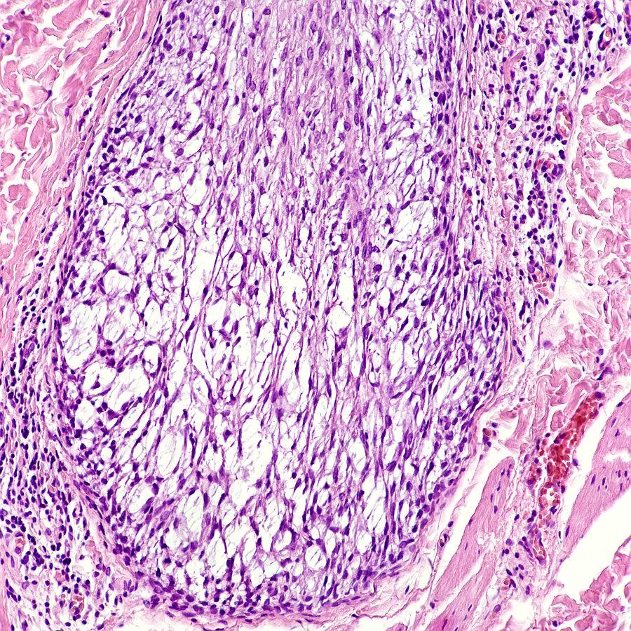 3.. Atypický epitelový hlen-alopecia mucinosa Bazální membrána