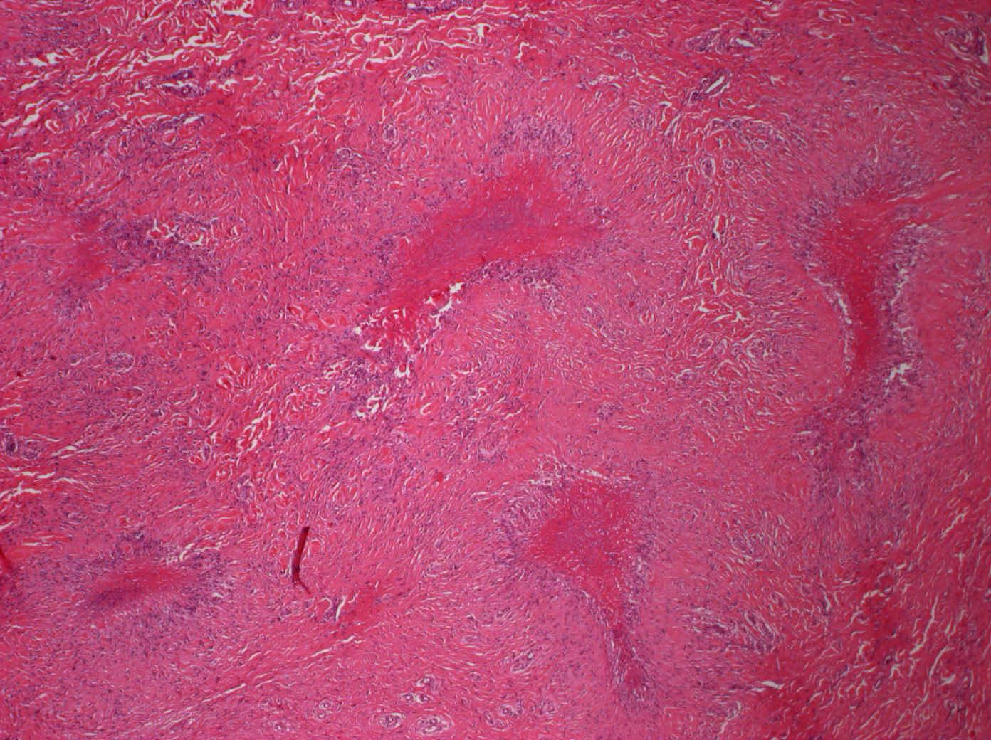 5. Fibrinoidní nekróza-periartikulární revmatický uzel 3 3 3