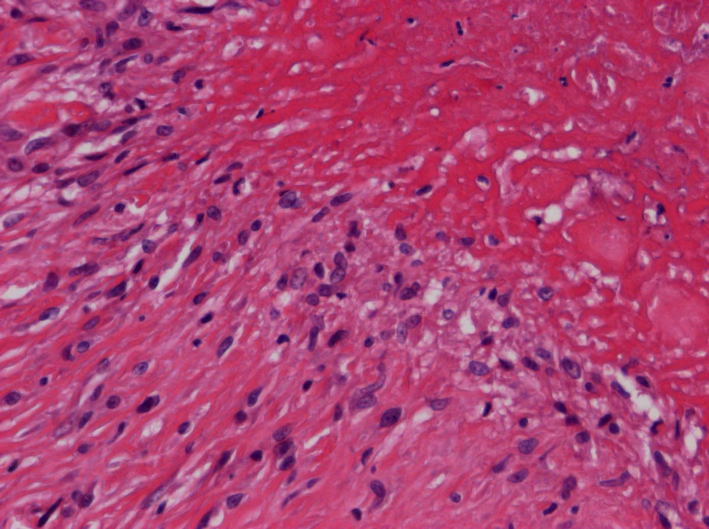 5.. Fibrinoidní nekróza-periartikulární revmatický
