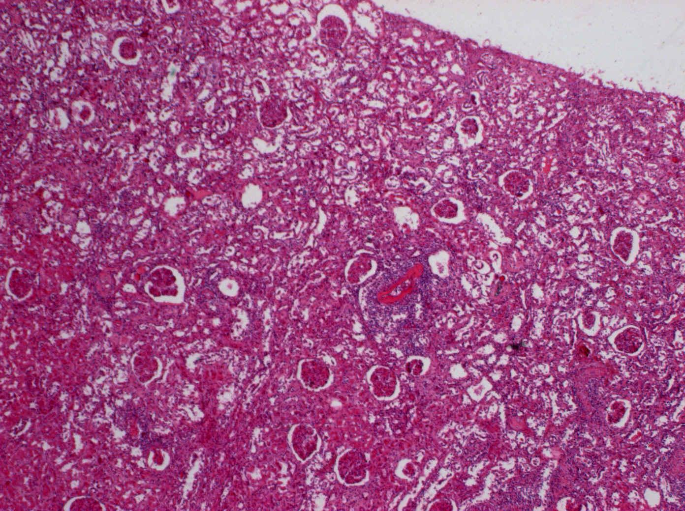 6. Fibrinoidní nekróza-arteriitis, přehled