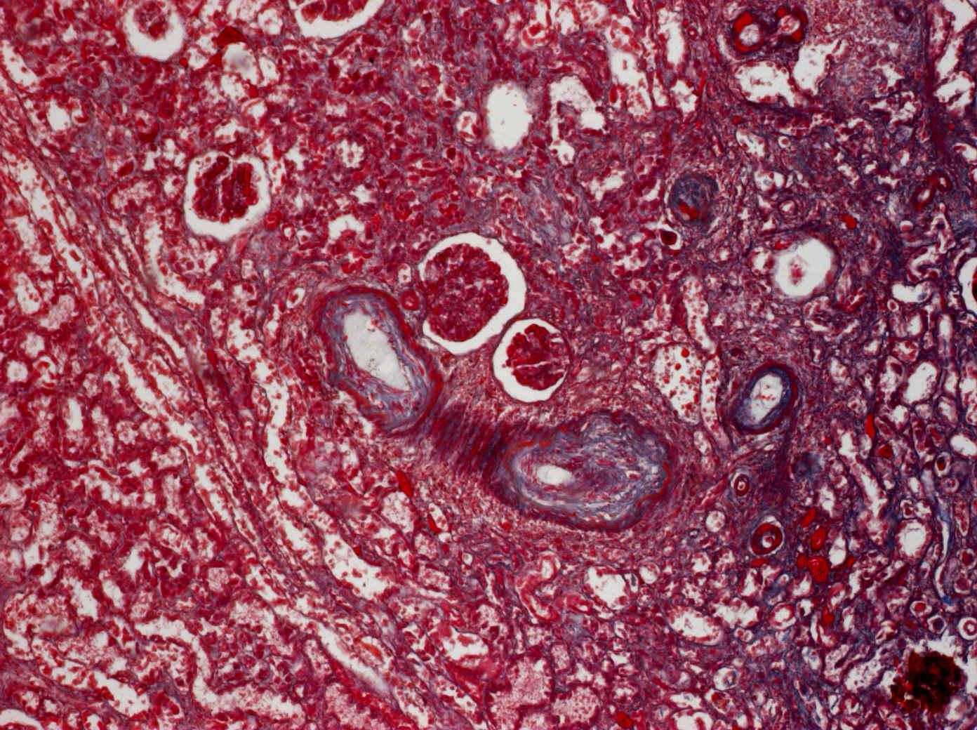 6.. Fibrinoidní nekróza-arteriitis, Malloryho trichrom