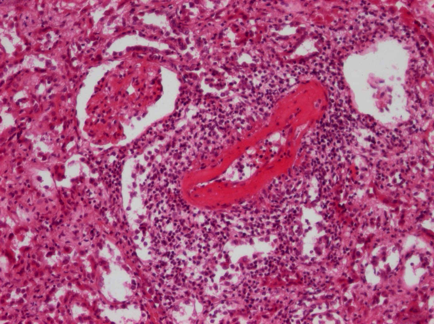 6.. Fibrinoidní nekróza arterioly ledviny Homogenizace