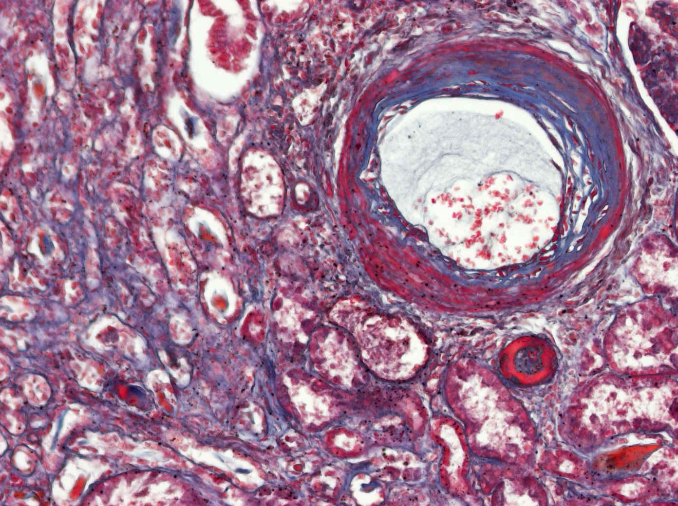6.3. Fibrinoidní nekróza-arteriitis, Malloryho trichrom Fibrinoidní