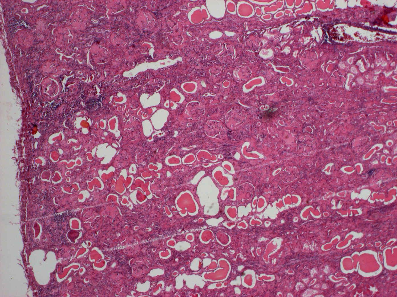8. Sekundární amyloidóza při myelomu-kůra