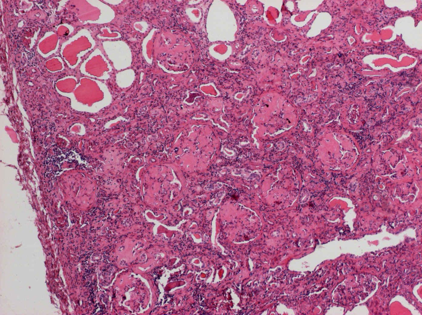 8.. Amyloidóza při myelomu-kůra ledviny, přehled 3 Glomeruly s