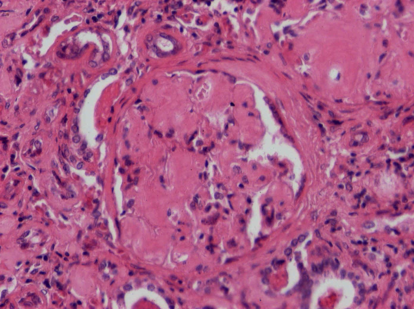 8.. Amyloidóza při myelomu-glomerulus, detail 4 3 Lobulární členění glomerulu nakupením amyloidu v