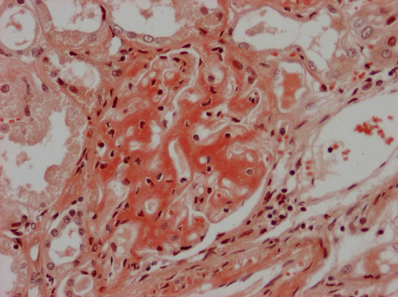 8.3. Amyloidóza při myelomu-glomerulus, detail,