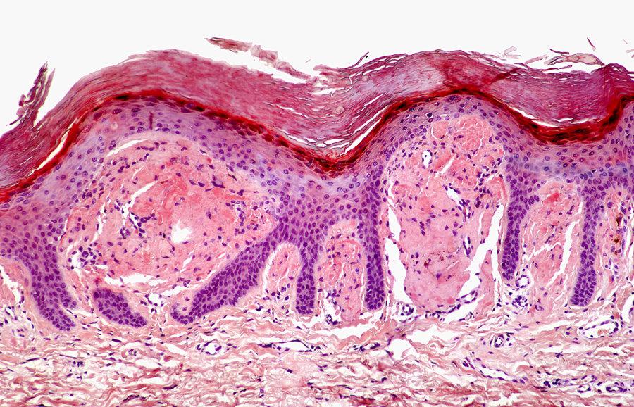 0. Kožní amyloid-kongo červeň Rohová vrstva