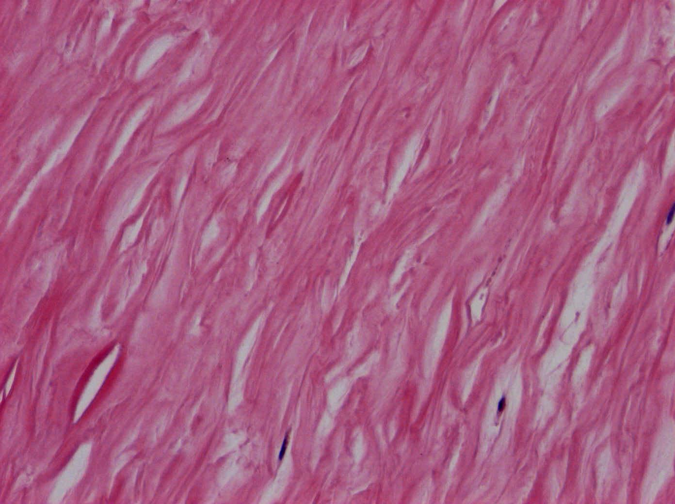 .4. Perisplenitis