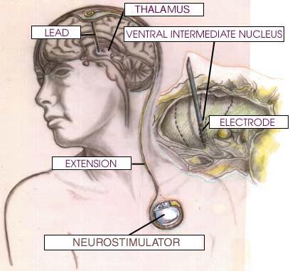 Hluboká mozková stimulace (deep-brain stimulation, DBS) Indikace: u refrakterních projevů