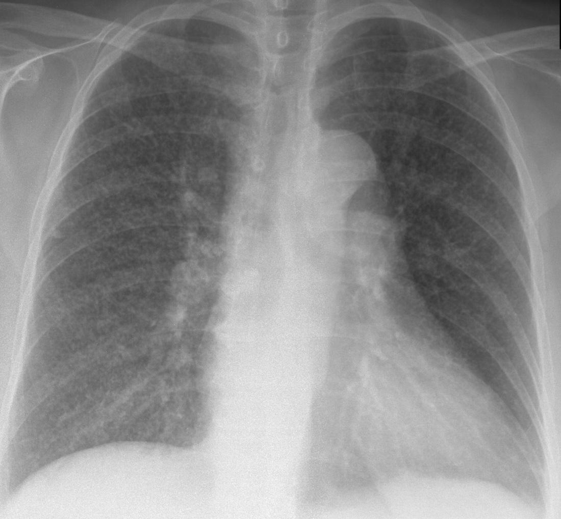 Intersticiální plicní proces u nemocné po Tx