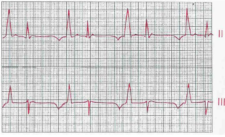 Komorová extrasystola (premature ventricular contraction, PVC) PREMATURE VENTRICULAR CONTRACTION A single