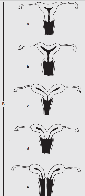 Obrázek 13: Vrozené vývojové vady dělohy [Zdroj: CITTERBART, Karel,